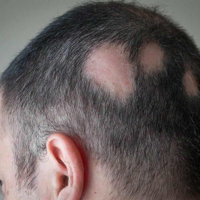 La chute des cheveux, les causes de cet maladie et que peut-on faire vraiment pour l’éviter ? La chute des cheveux, les causes de cet maladie et que peut-on faire vraiment pour l’éviter ?